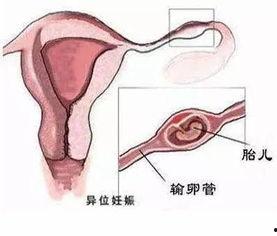 深圳宫外孕爆料新闻视频,生死时速,守护生命线 第2张 深圳宫外孕爆料新闻视频,生死时速,守护生命线 第2张
